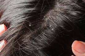 سر - مهم‌ترین علل شوره سر از زبان متخصص پوست و مو
