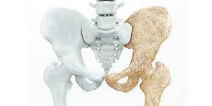 استخوان 300x150 - پوکی استخوان؛ نشانه ها، علائم و درمان
