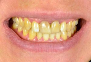 ۱۰ علت برای زرد شدن دندان‌‌ها