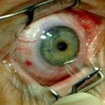 چشم 150x150 - عمل لیزیک چشم و شرایط آن